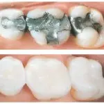 white fillings