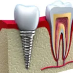 implants