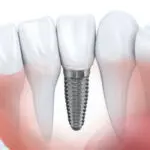 implant dentistry
