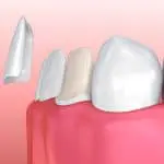 veneers s