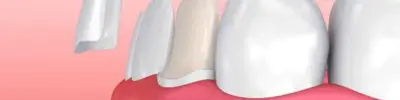 veneers s