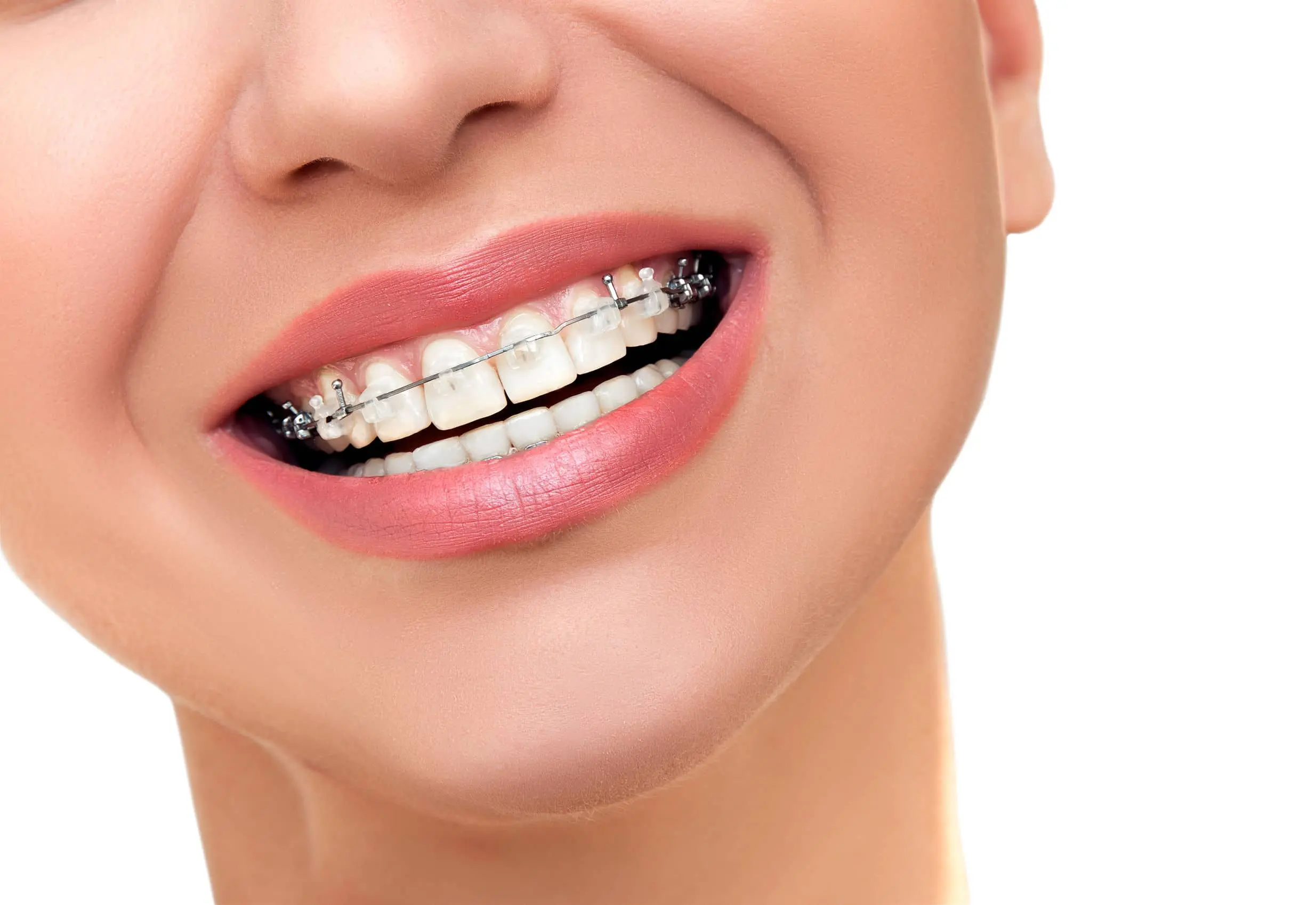 Ceramic Braces