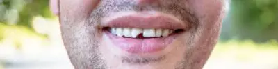 Chipped Tooth