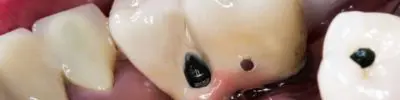 bone graft