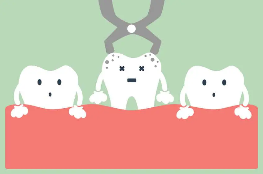 teeth extraction