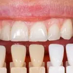 veneers s