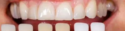 veneers s