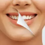 teeth whitening