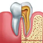 root canal treatment