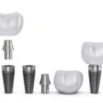 dental implants