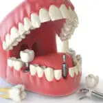 dental implants
