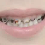 Cavities Not Just for Kids