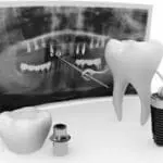 dental implants
