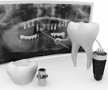 dental implants