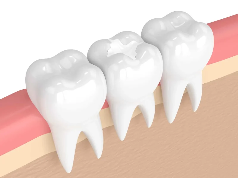 Dental implants