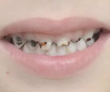 Cavities Not Just for Kids