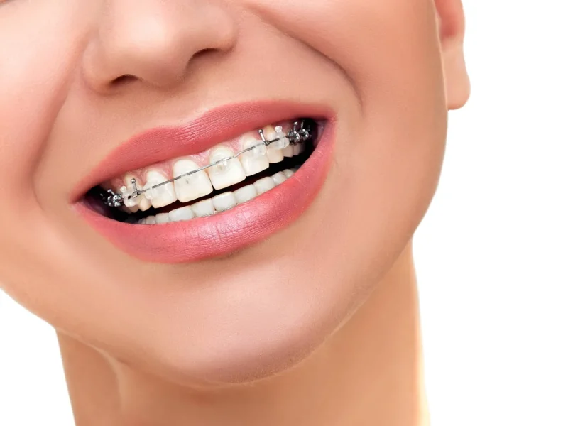 Ceramic Braces