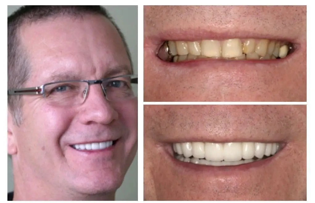 Smile restoration — veneers, crowns, and implants