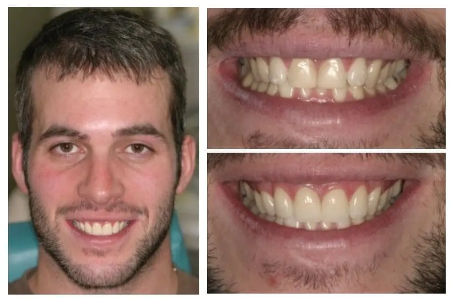 Porcelain veneers — four veneers replacing old bonding