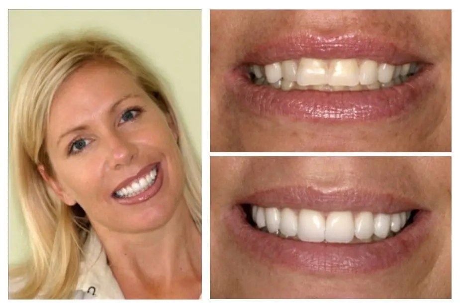 Smile design — ten new porcelain veneers