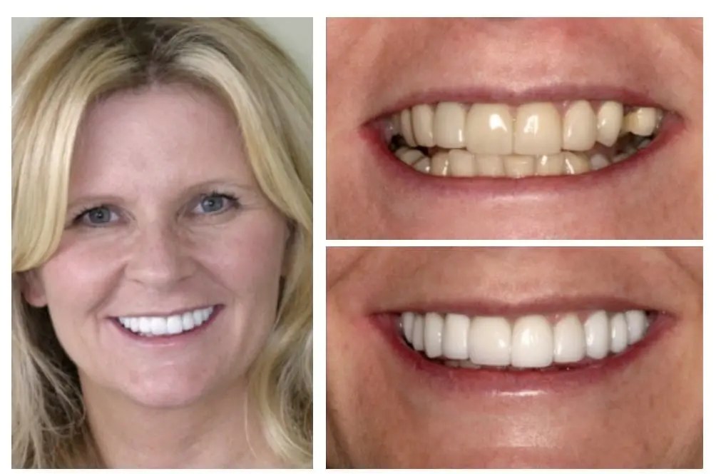 Veneers and bridge — old veneers replaced