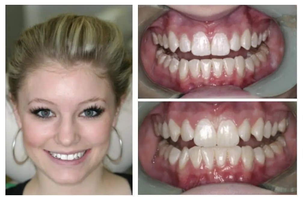 Invisalign treatment — rotated teeth aligned over 9 months