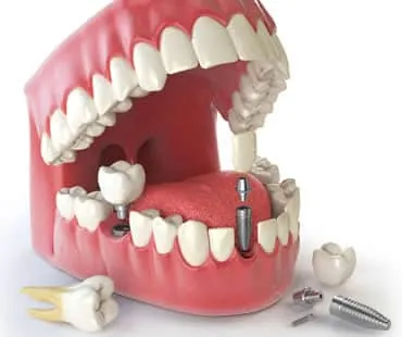 dental implants