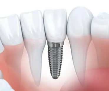 implant dentistry