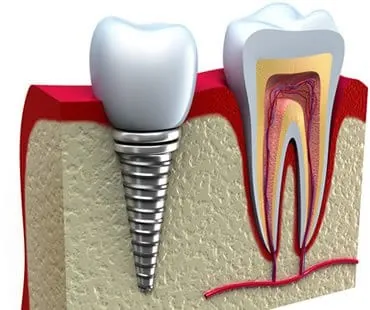 implants