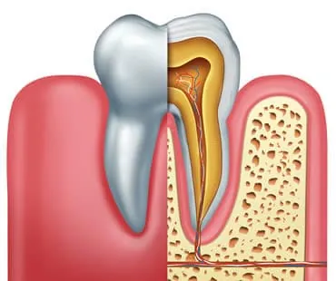 root canal treatment
