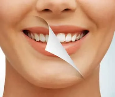 teeth whitening