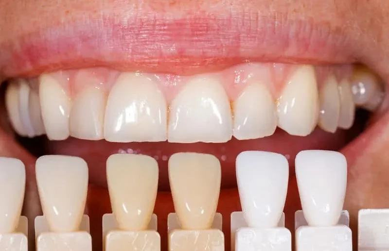 veneers s