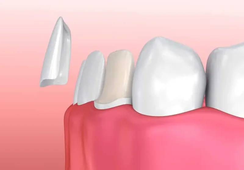 veneers s