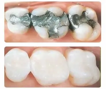 white fillings